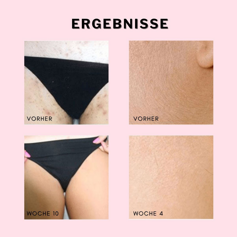 WONDER SKIN HAIR REMOVAL ORGINAL CLASSIC PRO (2in1 Modi)